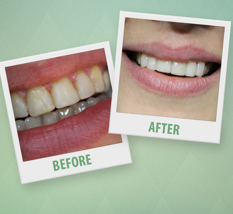 Veneers Make Over