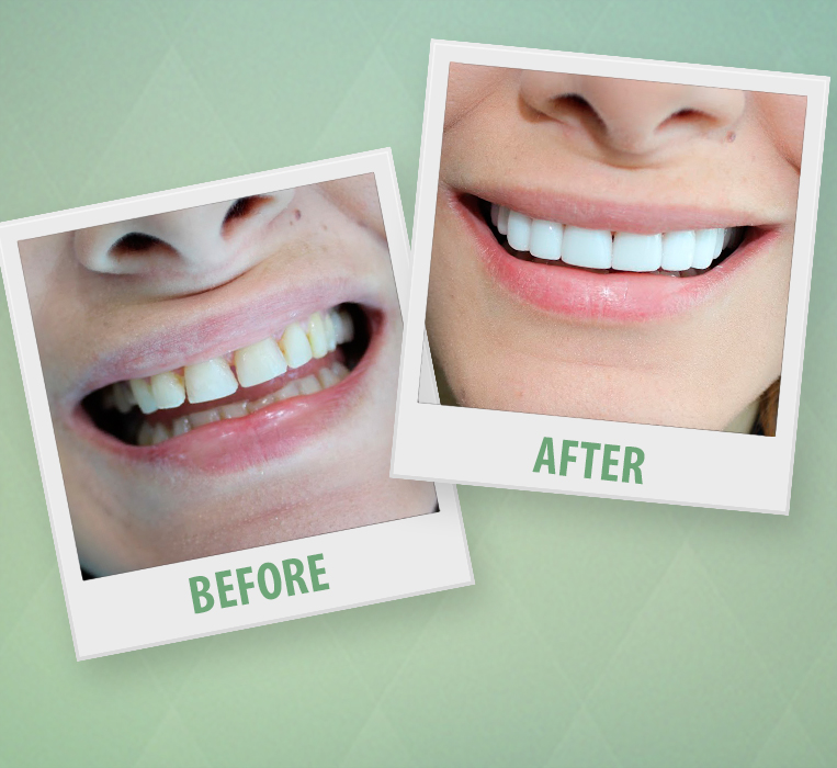 Veneers Makeover