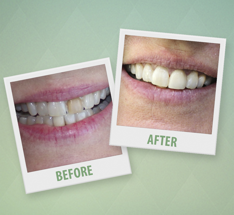 Single Veneer Fix