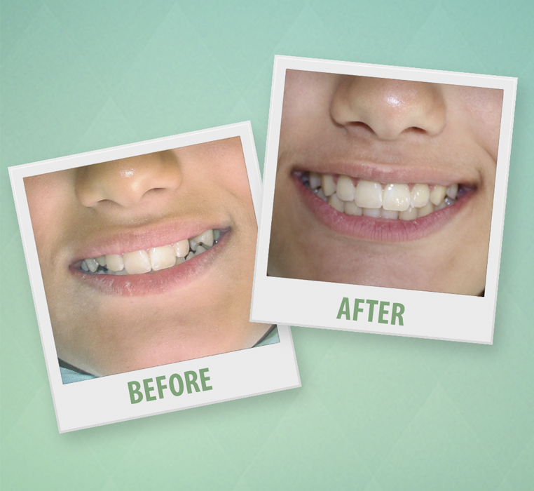 Braces / 1 year