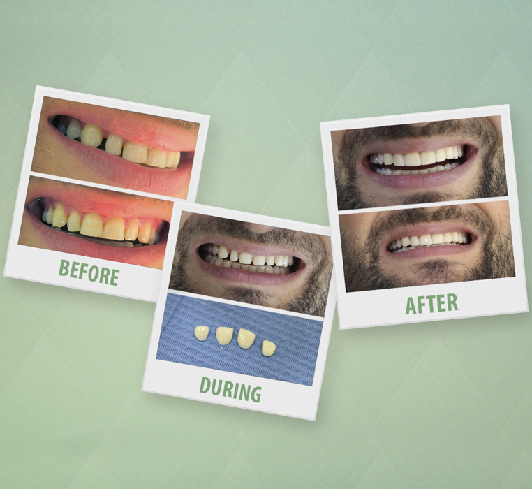 Facette Veneer